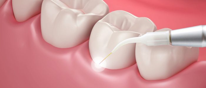 tecnologia-laser-dental-cibao-spa-odontologia